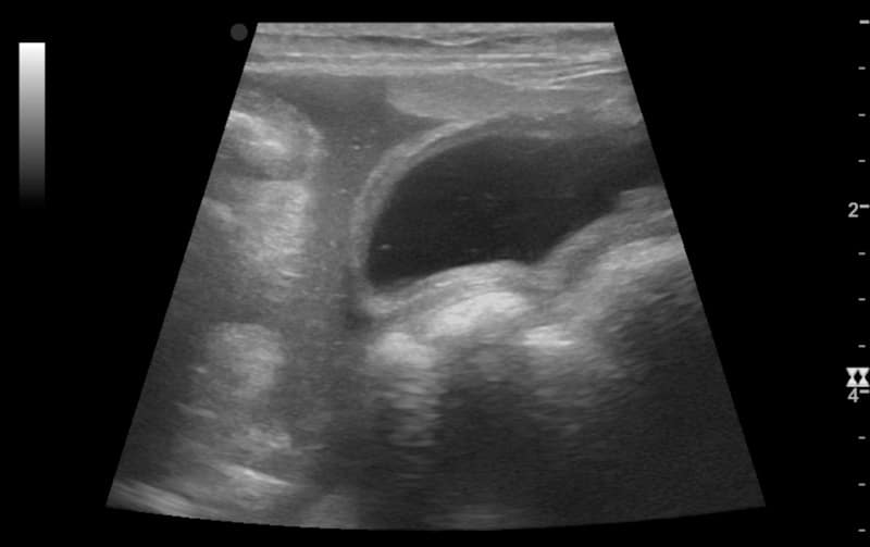 Ultrasound image showing showing fluid which may be blood