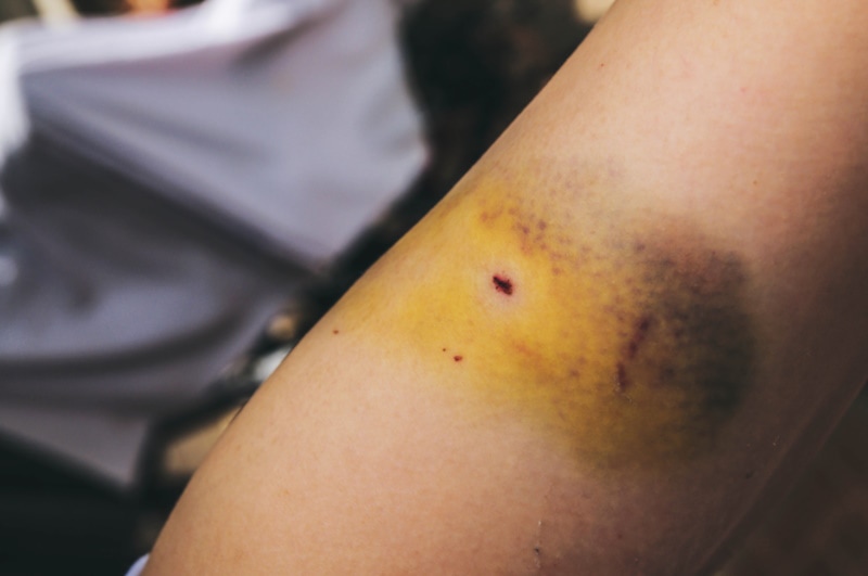 Bruise from a cat bite
