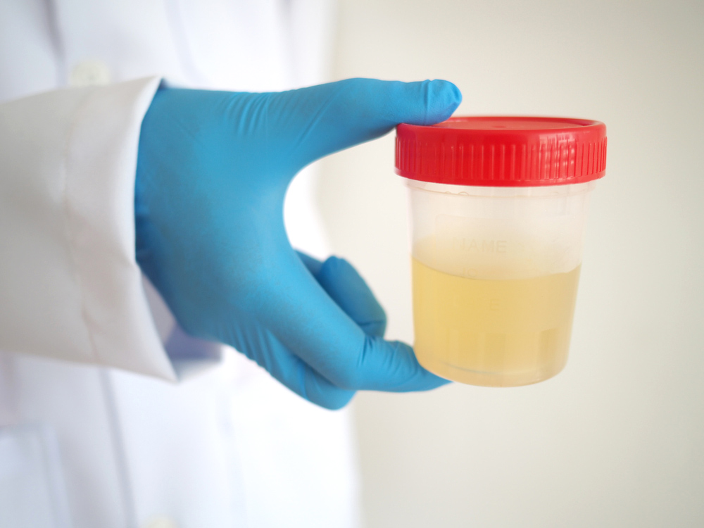 medical urine sample